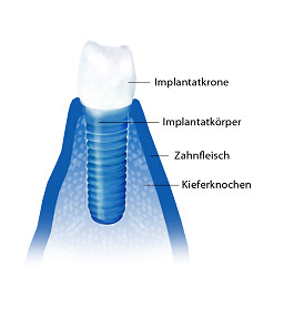 Schema eines Zahnimplantats mit Implantatkrone, Implantatkoerper, Zahnfleisch und Kieferknochen