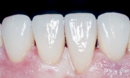 Fertiges Ergebnis mit Veneers im Frontzahnbereich