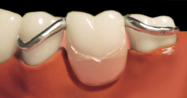 Kombinierter Zahnersatz mit verdeckten Halteelementen