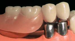 Röntgenaufnahme mit Implantaten